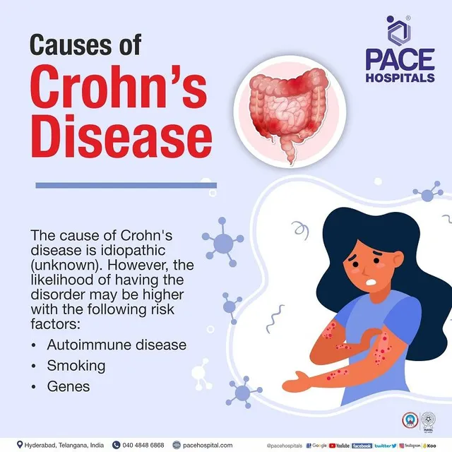 What Is Crohn’s Disease? Symptoms, Causes, and Treatment