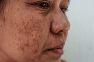 Skin Discoloration