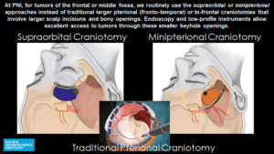 Understanding Brain Tumours