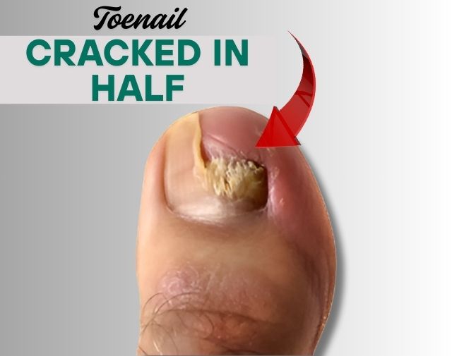 Cracked Nails