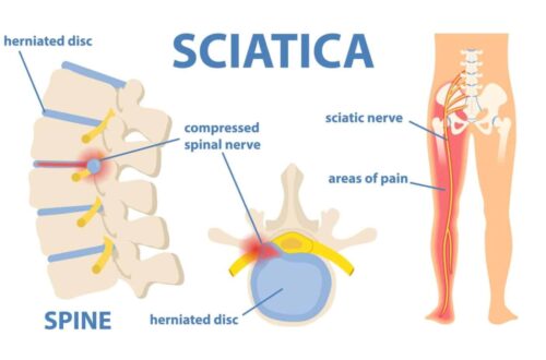 Sciatica