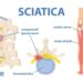 Sciatica