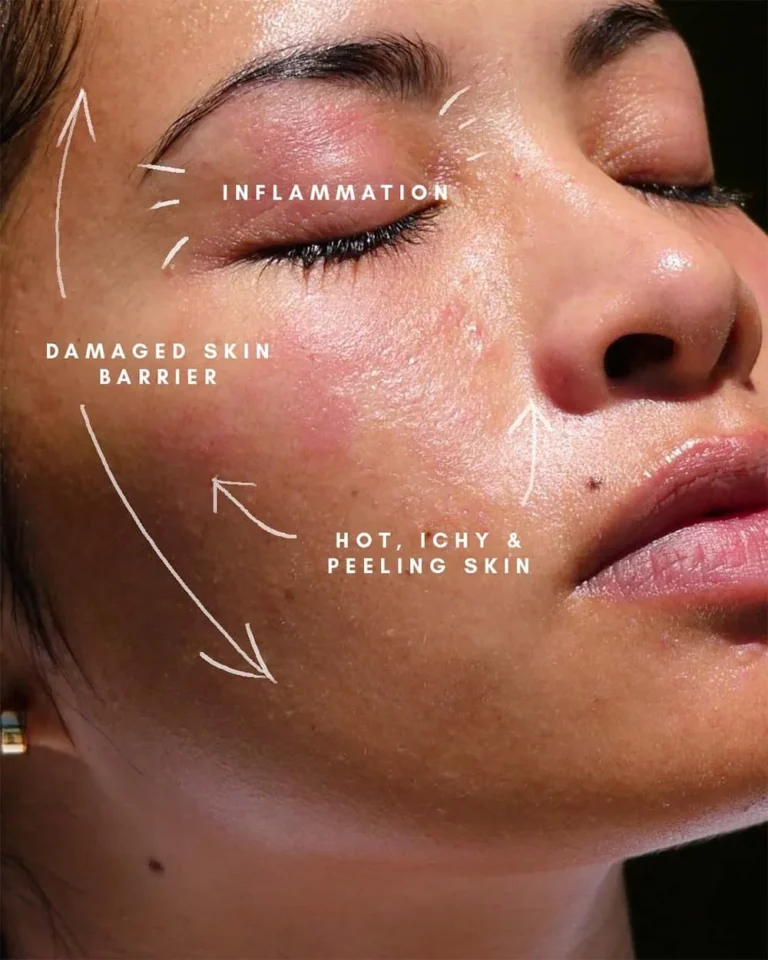Damaged Skin Barrier?