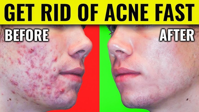Get rid of acne