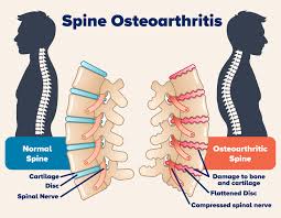 Age-related spinal diseases